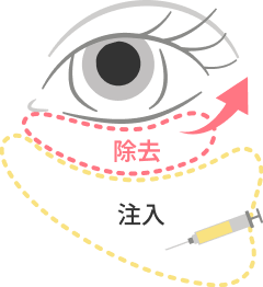 脱脂・脂肪注入のアイコン