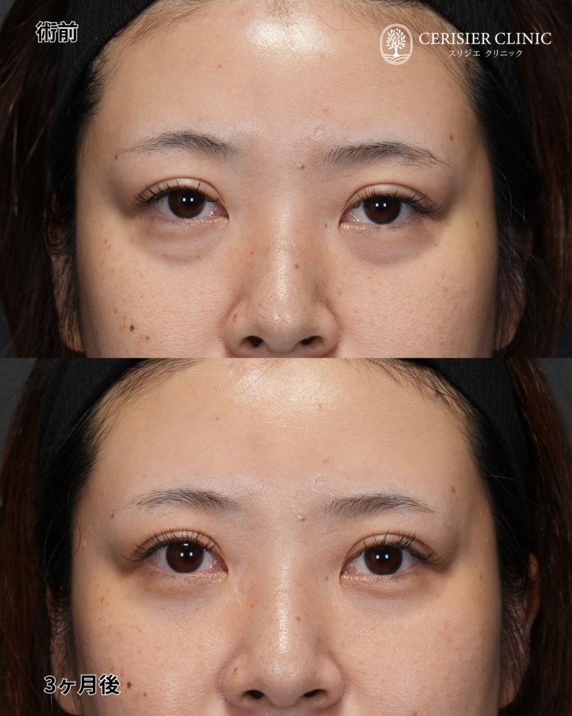 裏ハムラ 30代女性