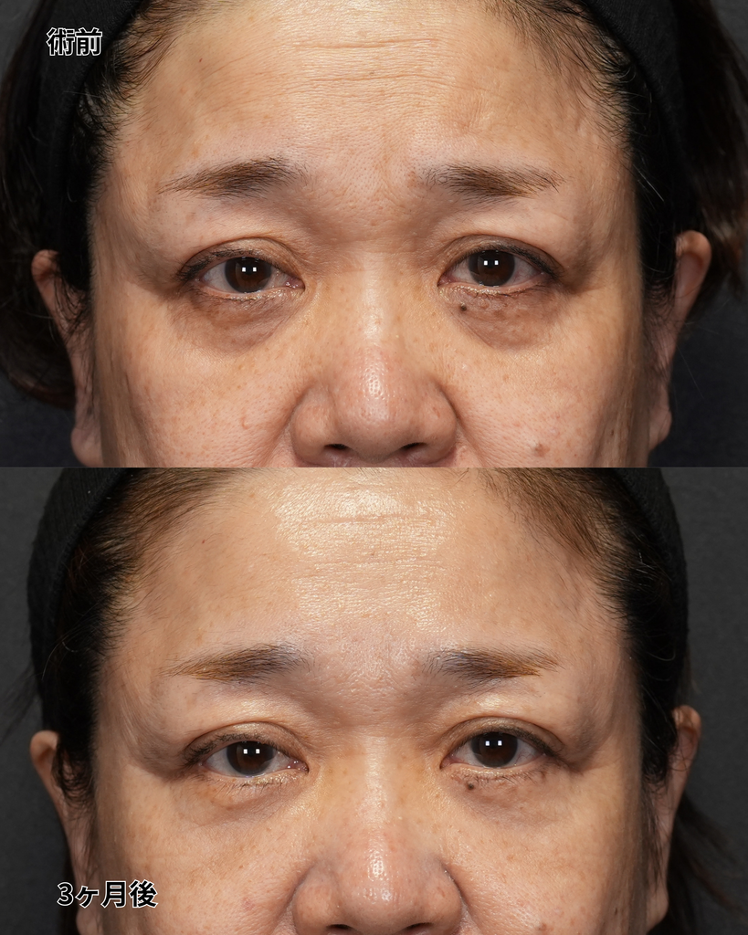 表ハムラ 60代女性