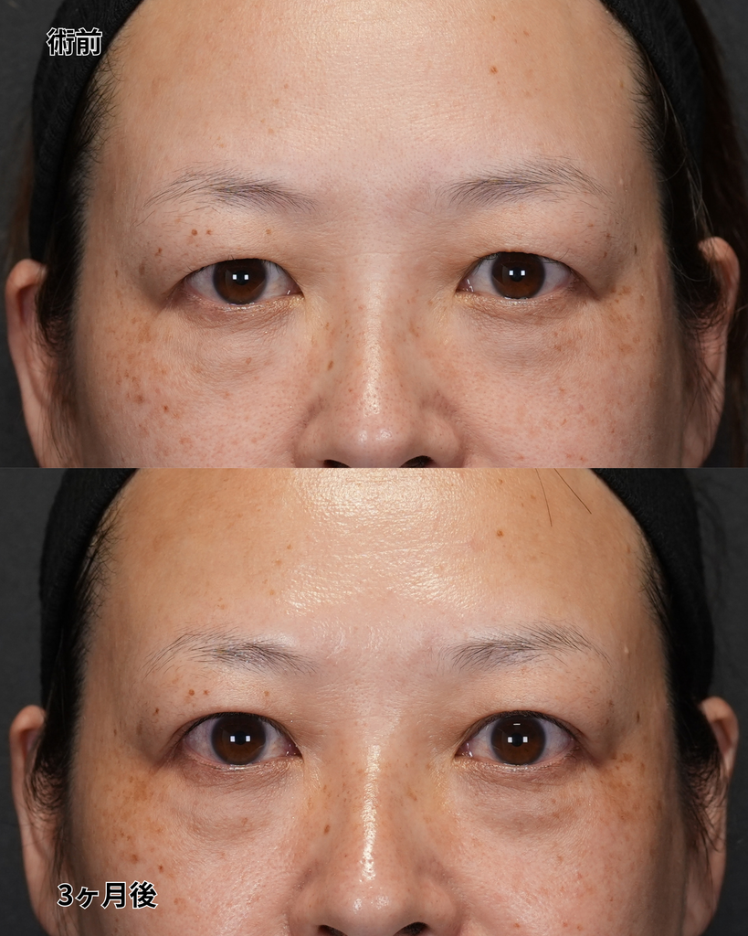 二重埋没法 40代女性