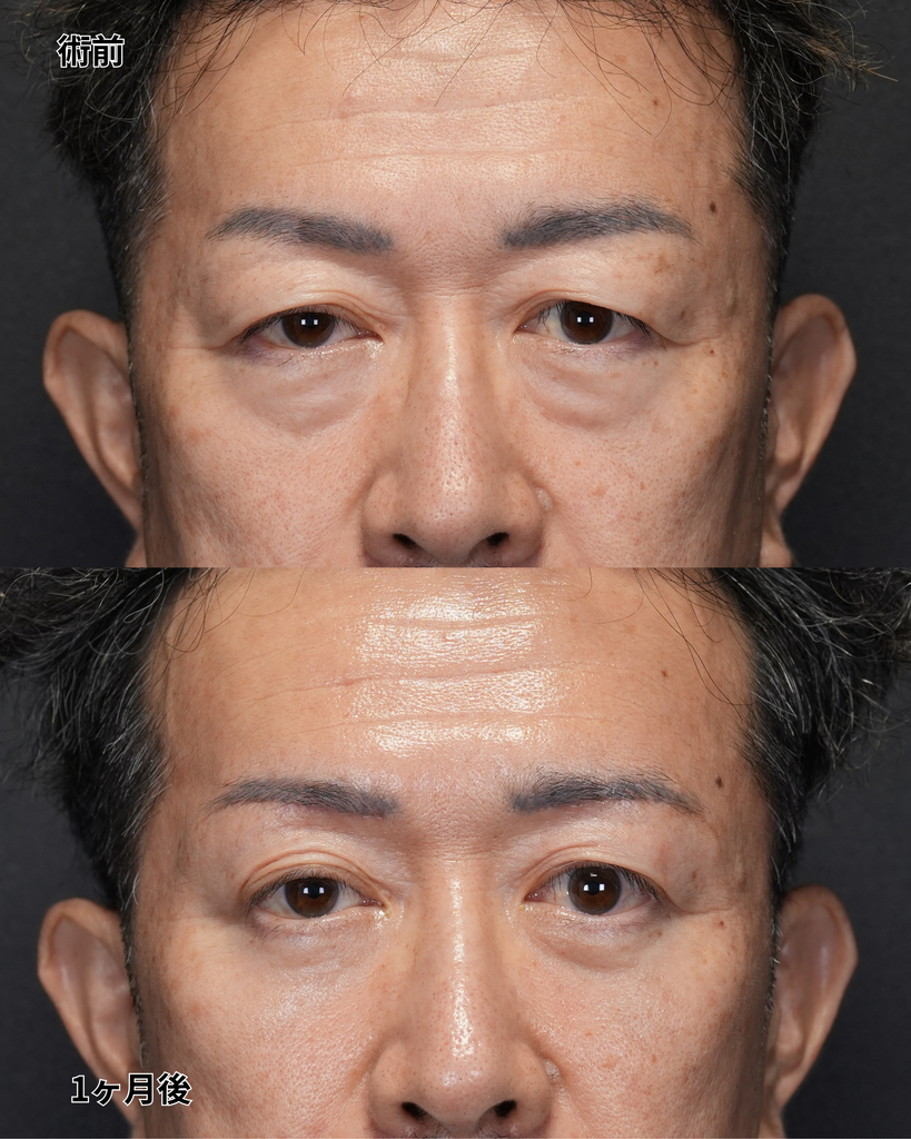 裏ハムラ・眉毛下切開 50代男性