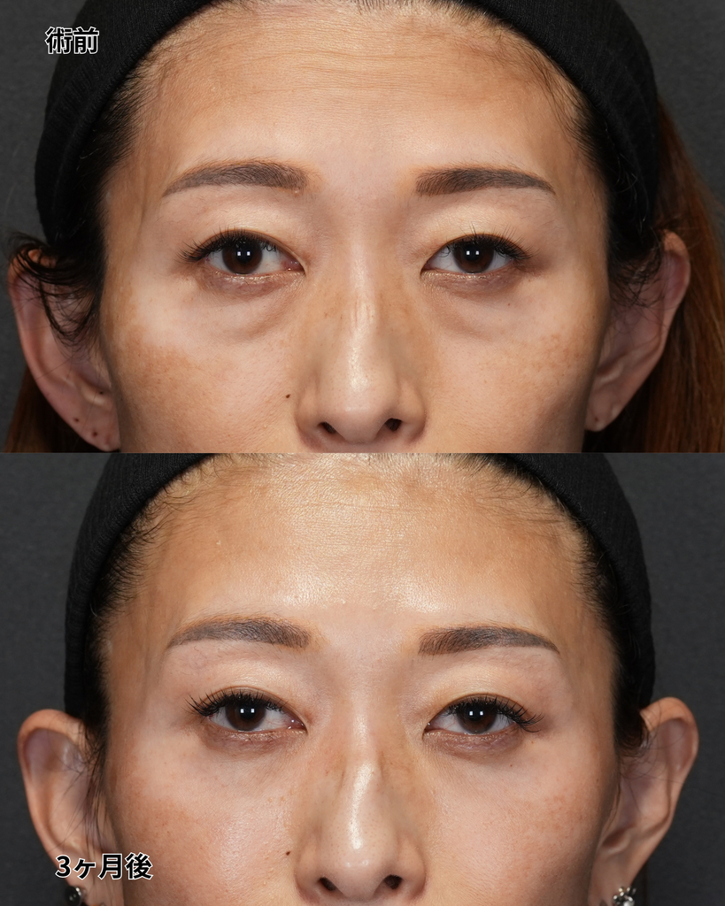 裏ハムラ 40代女性