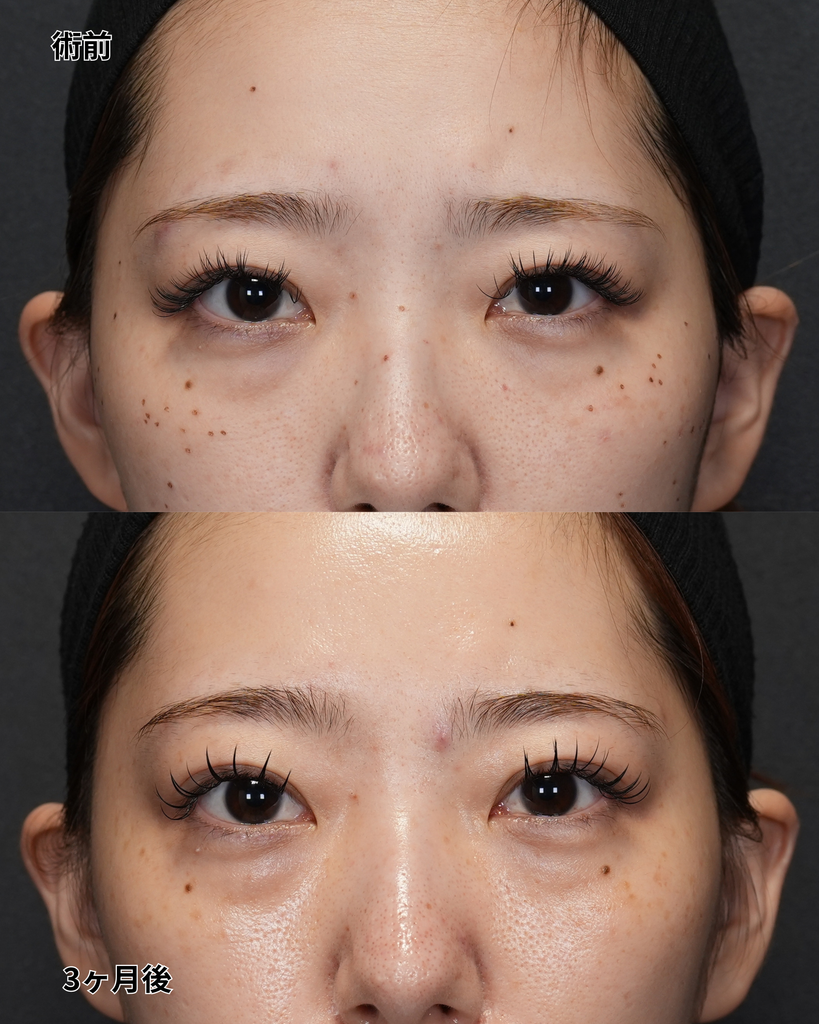 二重埋没法 20代女性