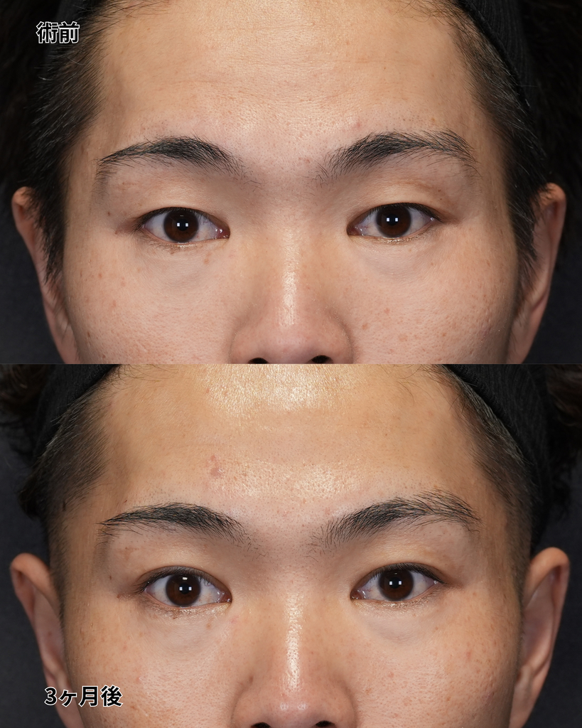 二重埋没法 20代男性