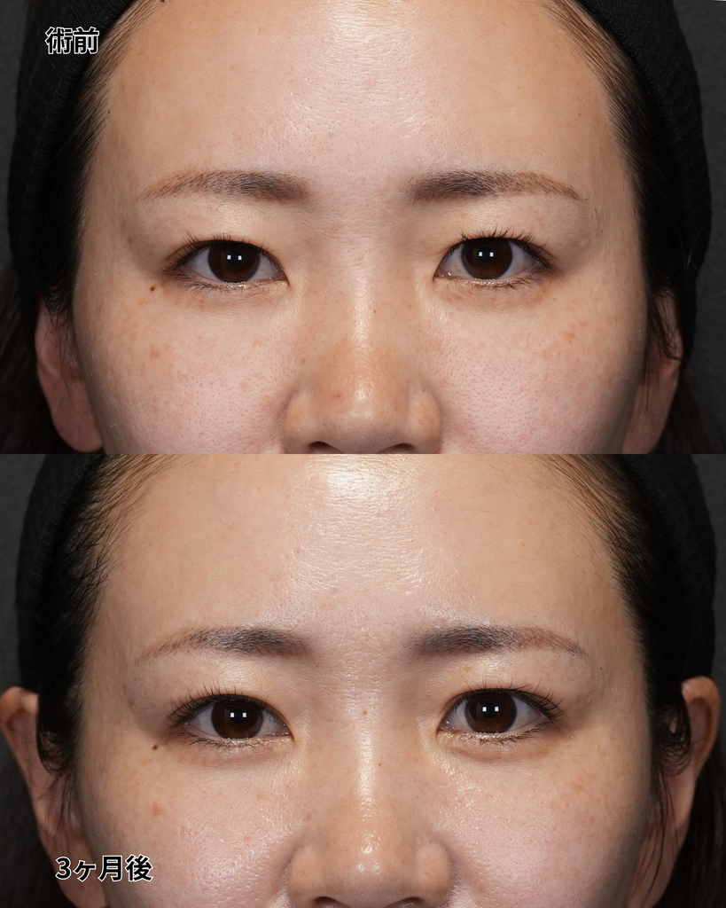 二重埋没法 30代女性