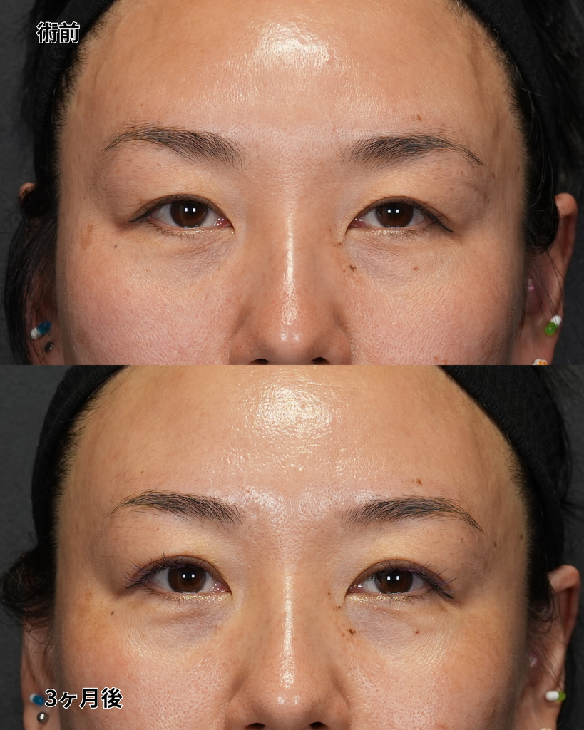 二重埋没法 40代女性
