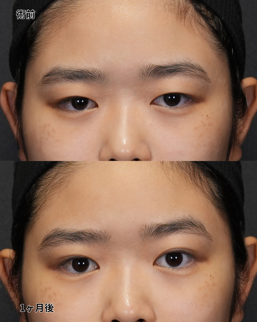 二重埋没法 10代女性