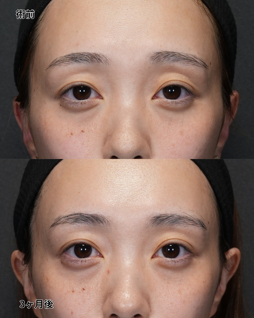 二重埋没法 20代女性
